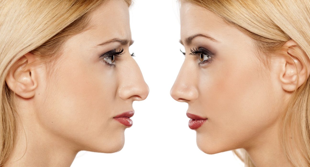 rhinoplasty